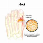 Does Bread Affect Gout