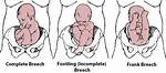Does Breech Head Go Away