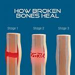 Does Broken Bones Qualify for Disability?