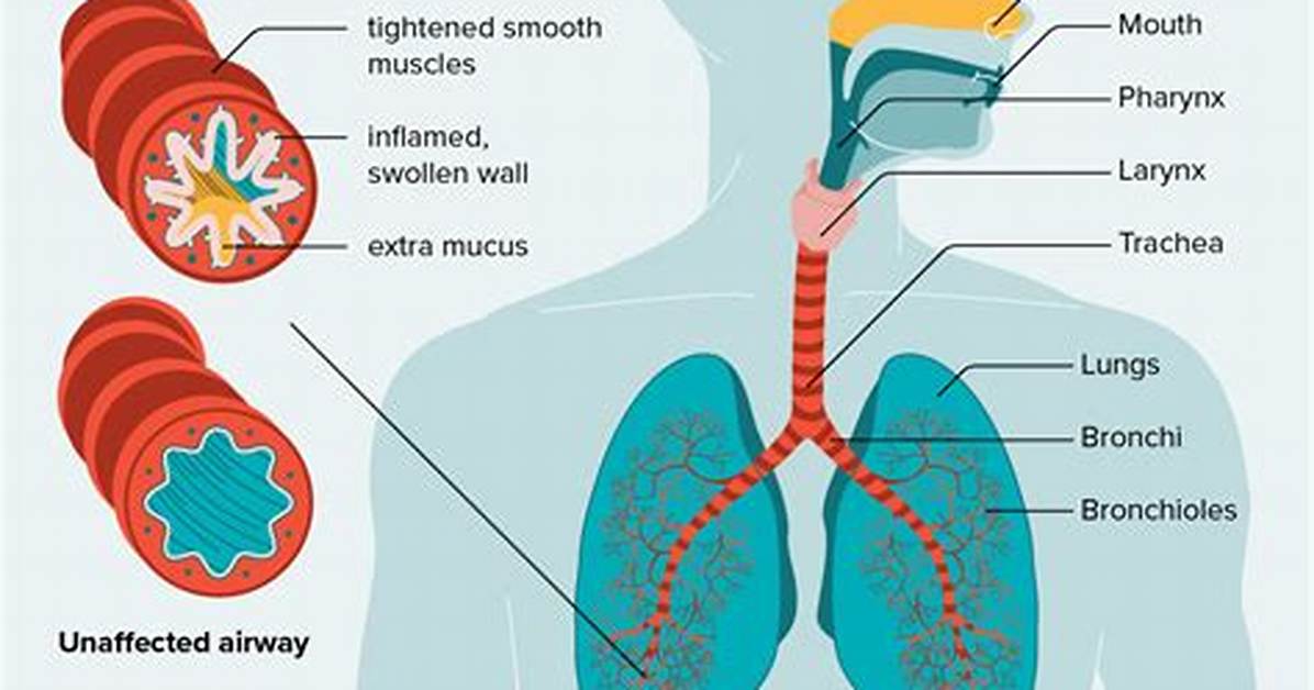 Does Bronchiolitis Cause Asthma?