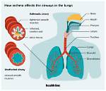 Does Bronchiolitis Cause Asthma?
