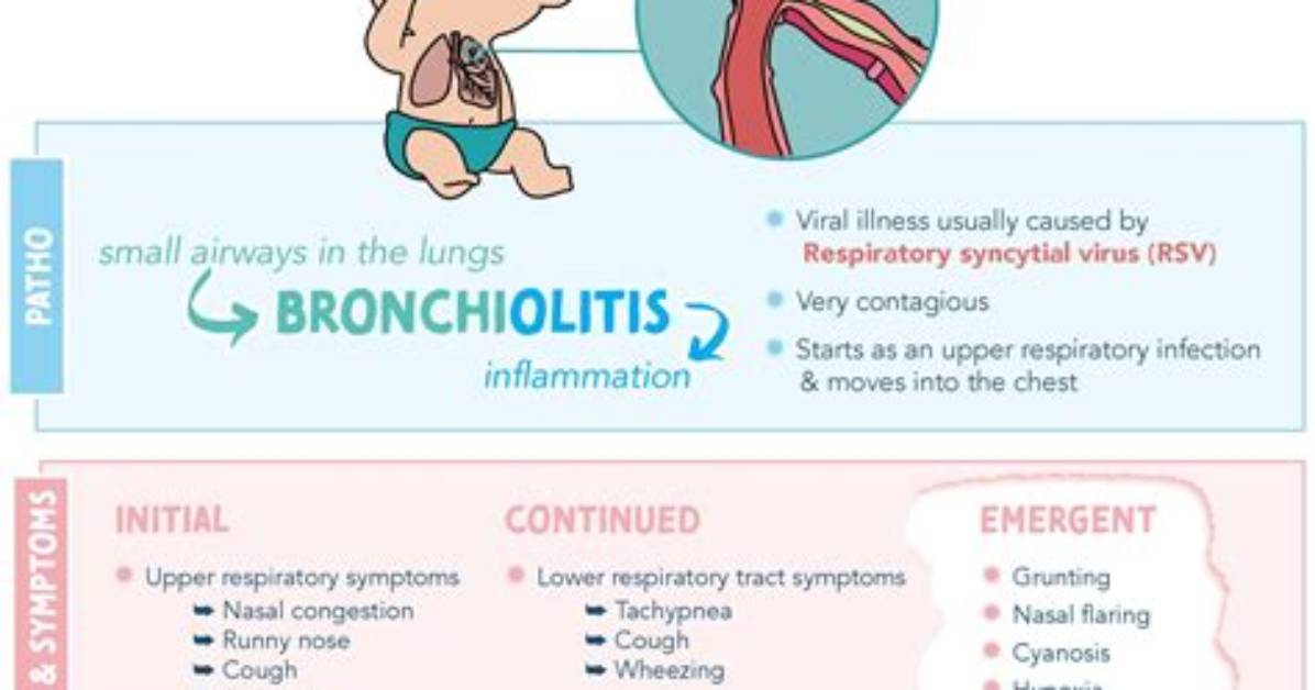 Does Bronchiolitis Go Away?