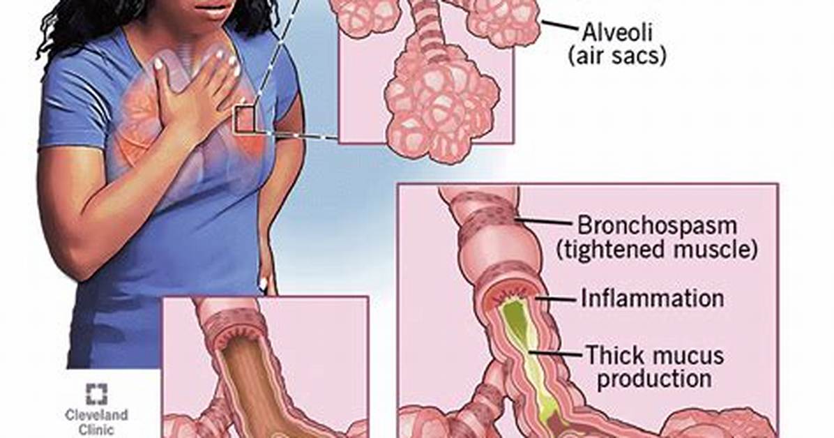 Does Bronchitis Mean Asthmatic?