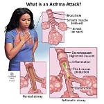 Does Bronchitis Mean Asthmatic?