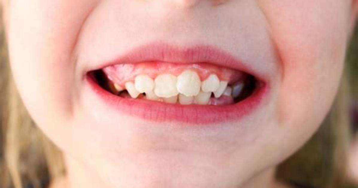 Does Buck Teeth Affect Speech?