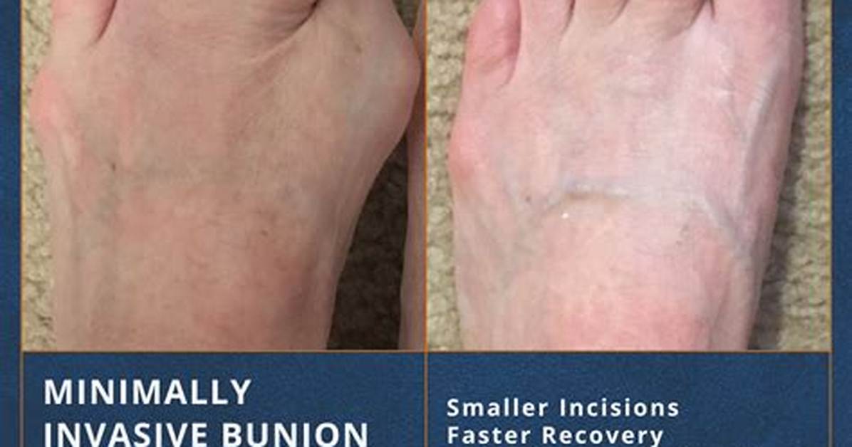 Does Bunion Surgery Work?