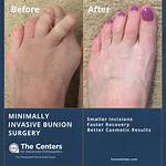 Does Bunion Surgery Work?