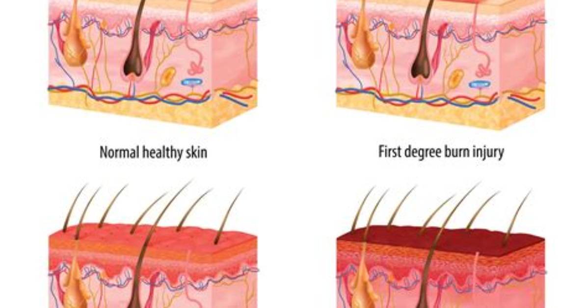 Does Burn Affect Facade?
