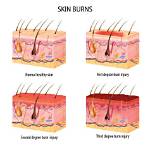 Does Burn Affect Facade?