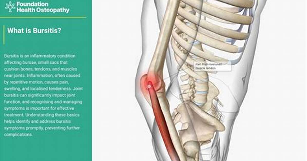 Does Bursitis Go Away?
