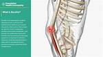 Does Bursitis Go Away?