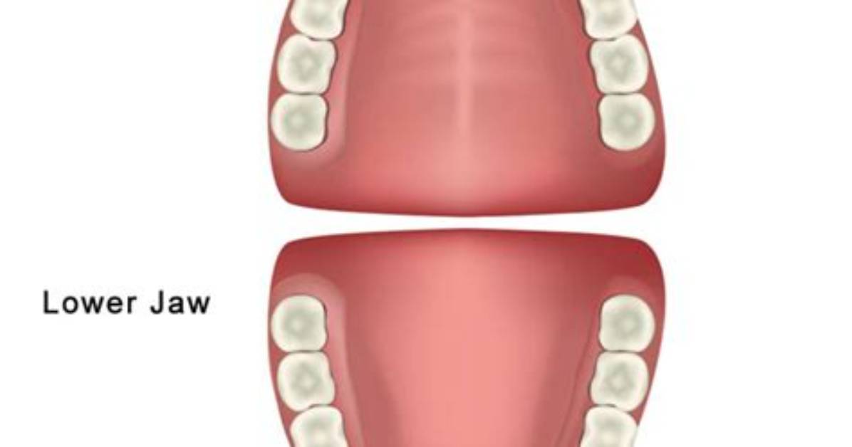 Does Byte Move Premolars?