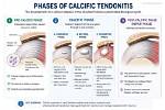 Does Calcification Go Away
