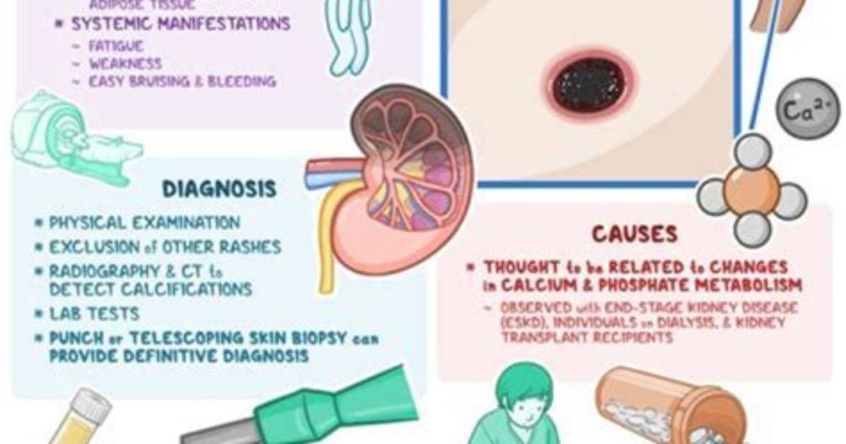 Does Calciphylaxis Go Away