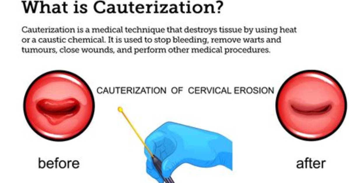 Does Cauterizing a Wound Really Work