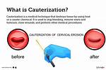 Does Cauterizing a Wound Really Work
