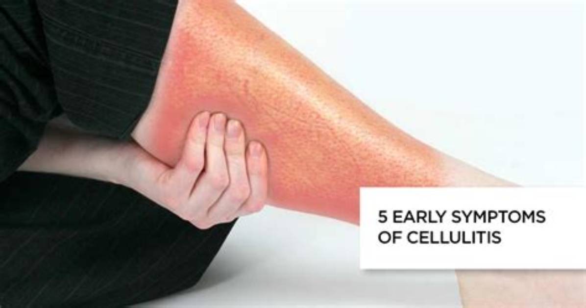 Does Cellulitis Make You Tired?