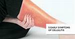 Does Cellulitis Make You Tired?
