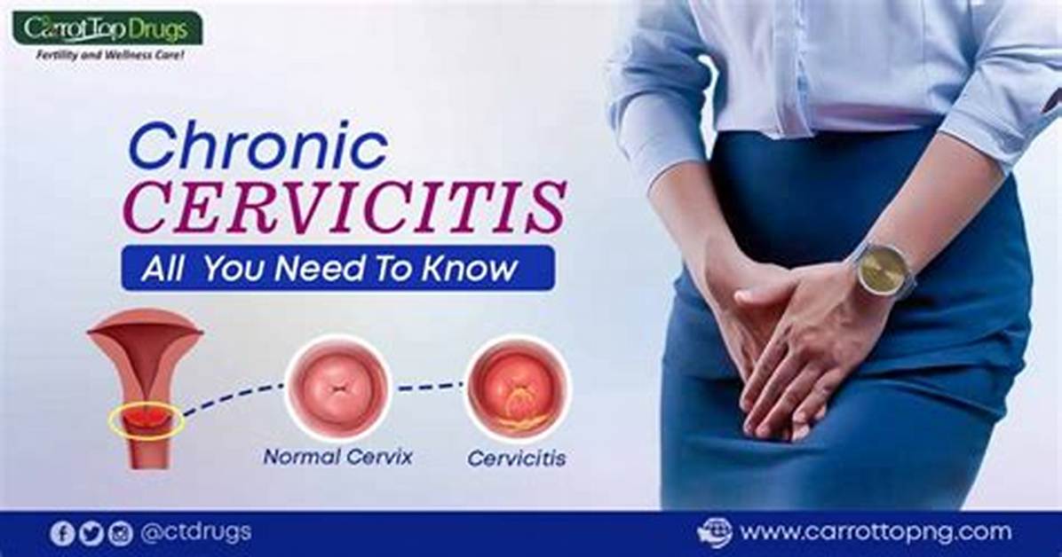 Does Cervicitis Cause Itching?