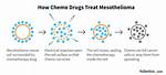 Does Chemo Help Mesothelioma?