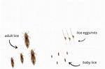 Does Chlorine Kill Lice