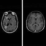 Does Choking Cause Brain Damage?