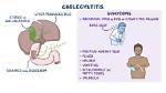 Does Cholecystitis Cause Pain?