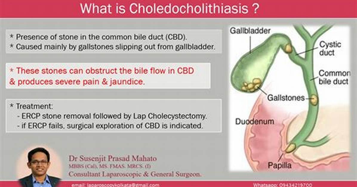 Does Choledocholithiasis Need Surgery?