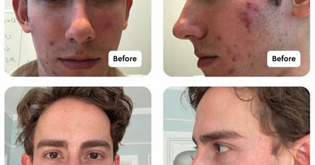 Does Cloderm Help Acne?
