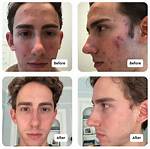 Does Cloderm Help Acne?