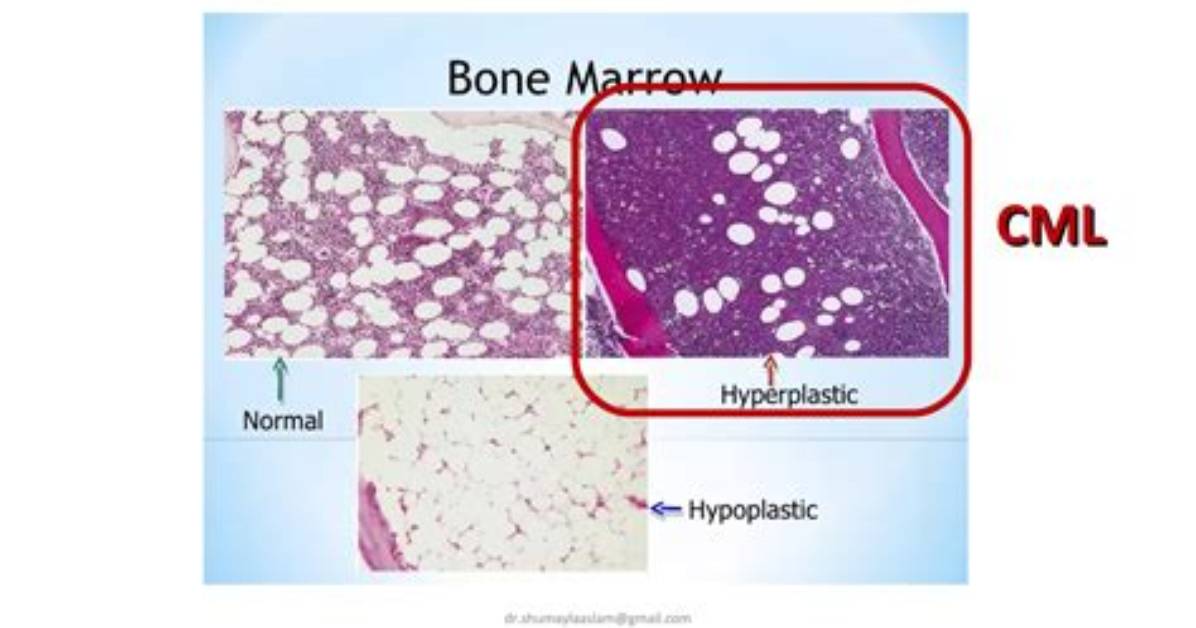 Does Cml Cause Bone Pain?