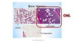 Does Cml Cause Bone Pain?