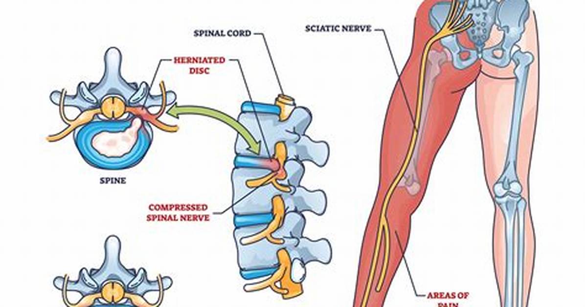 Does Colocynthis Work for Sciatica?