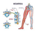 Does Colocynthis Work for Sciatica?