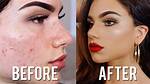 Does Concealer Cover Scars?