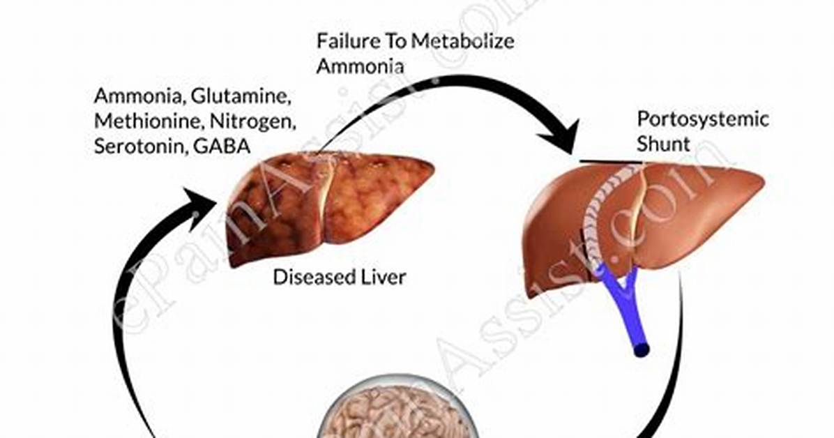 Does Constipation Cause Hepatic Encephalopathy?