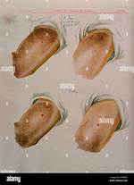 Does Cowpox Stop Smallpox?