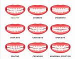 Does Crooked Teeth Affect Singing?