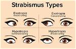 Does Cross Eyed Affect Vision?