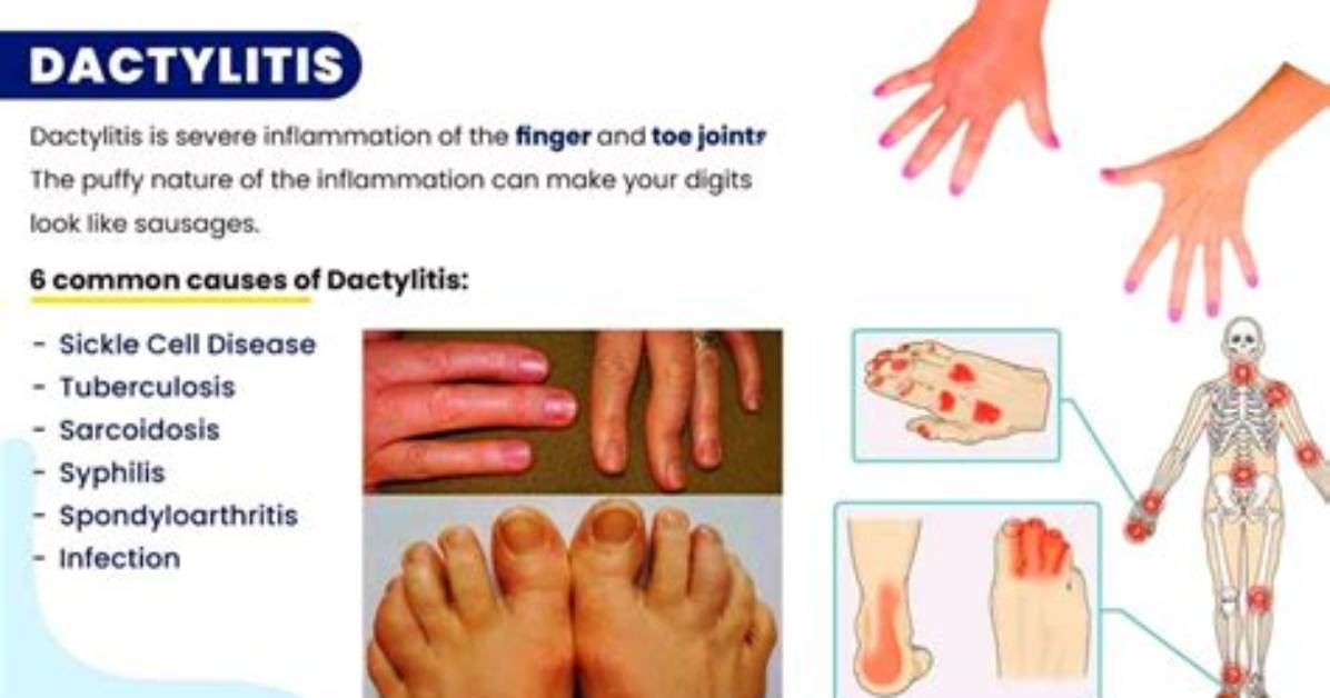 Does Dactylitis Go Away?