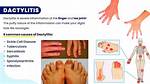 Does Dactylitis Go Away?