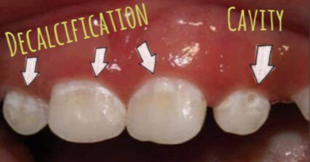 Does Decalcification Go Away?