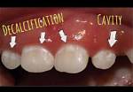 Does Decalcification Go Away?
