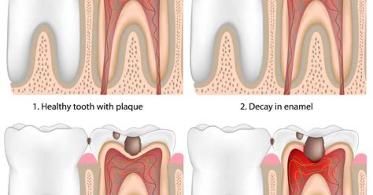 Does Dentine Grow Back?
