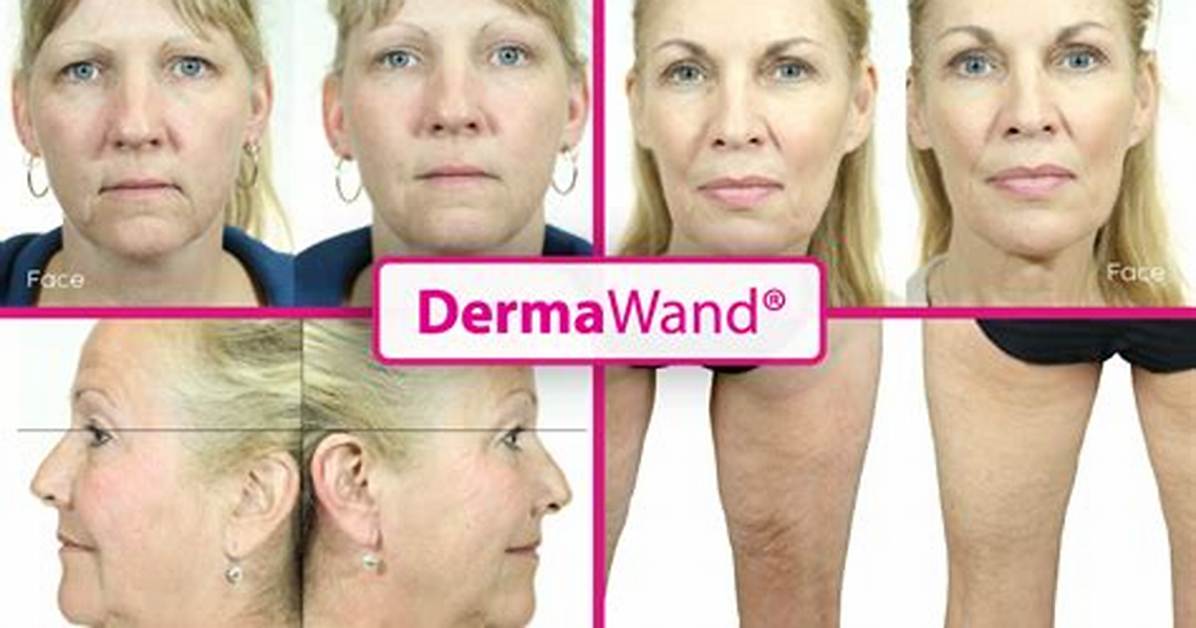 Does Derma Wand Really Work?