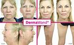 Does Derma Wand Really Work?