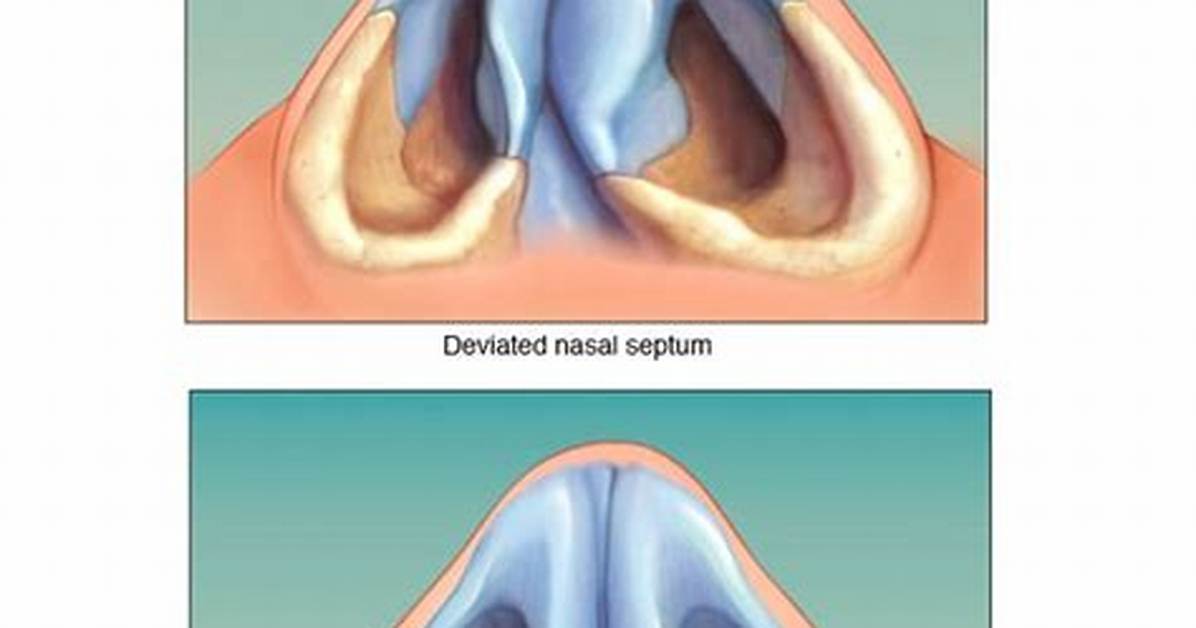 Does Deviated Septum Cause Headaches?
