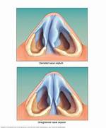 Does Deviated Septum Cause Headaches?