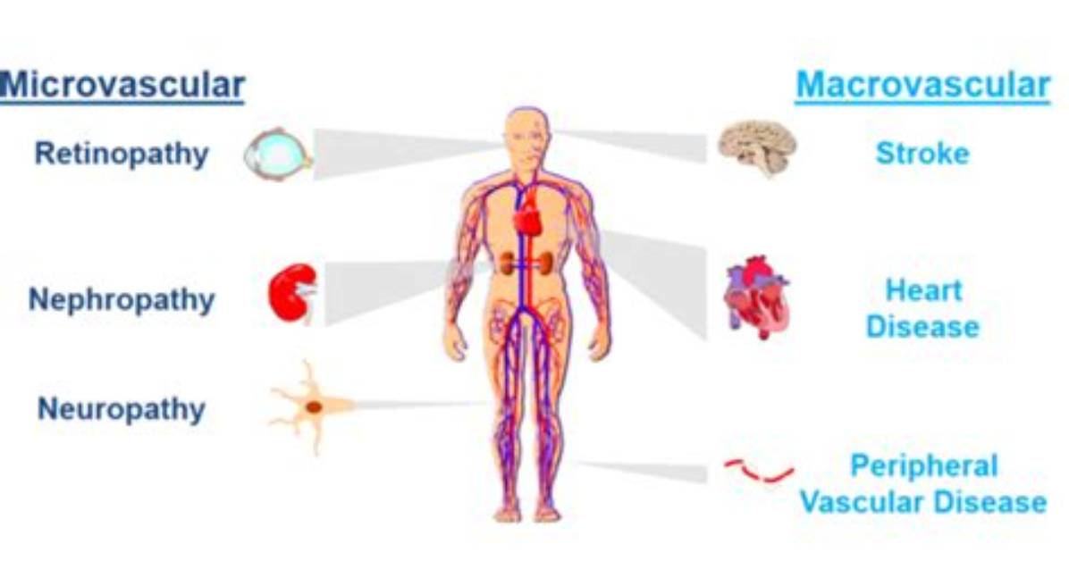 Does Diabetes Affect Perfusion?