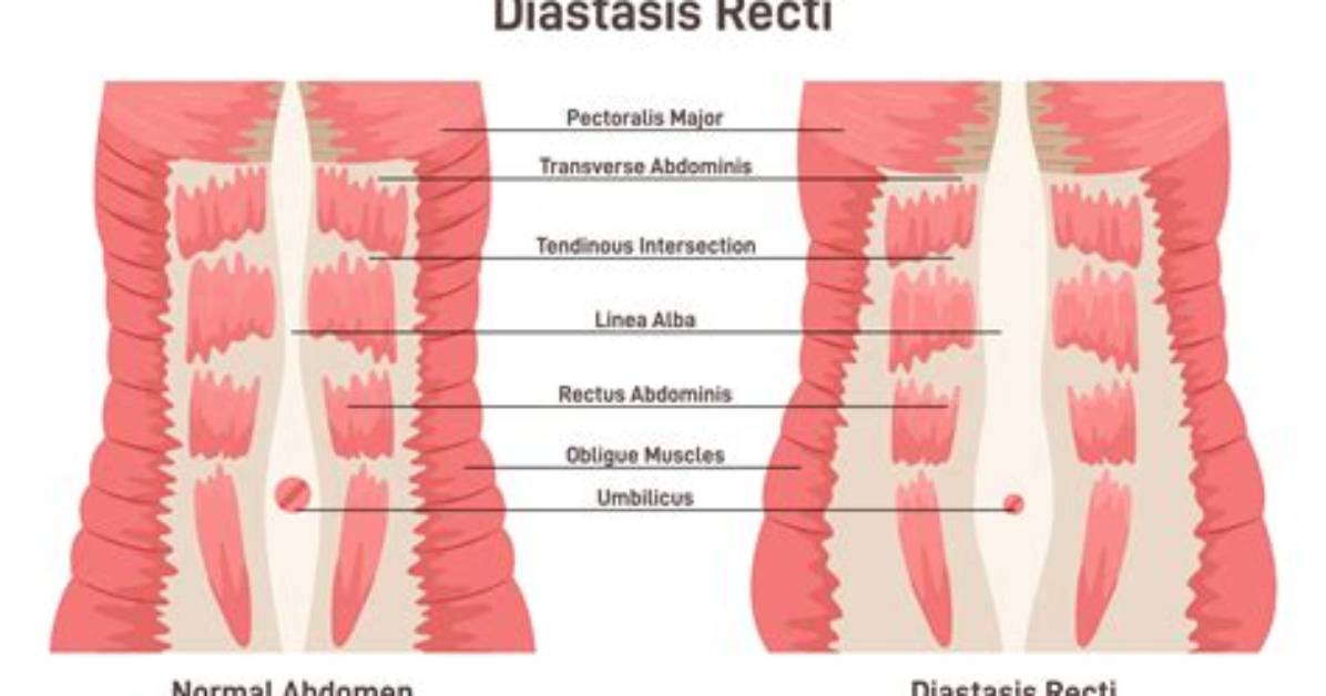 Does Diastasis Recti Affect Labor?